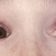 blue sclera.jpg
