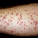 dermnet_rm_photo_of_guttate_psoriasis.jpg
